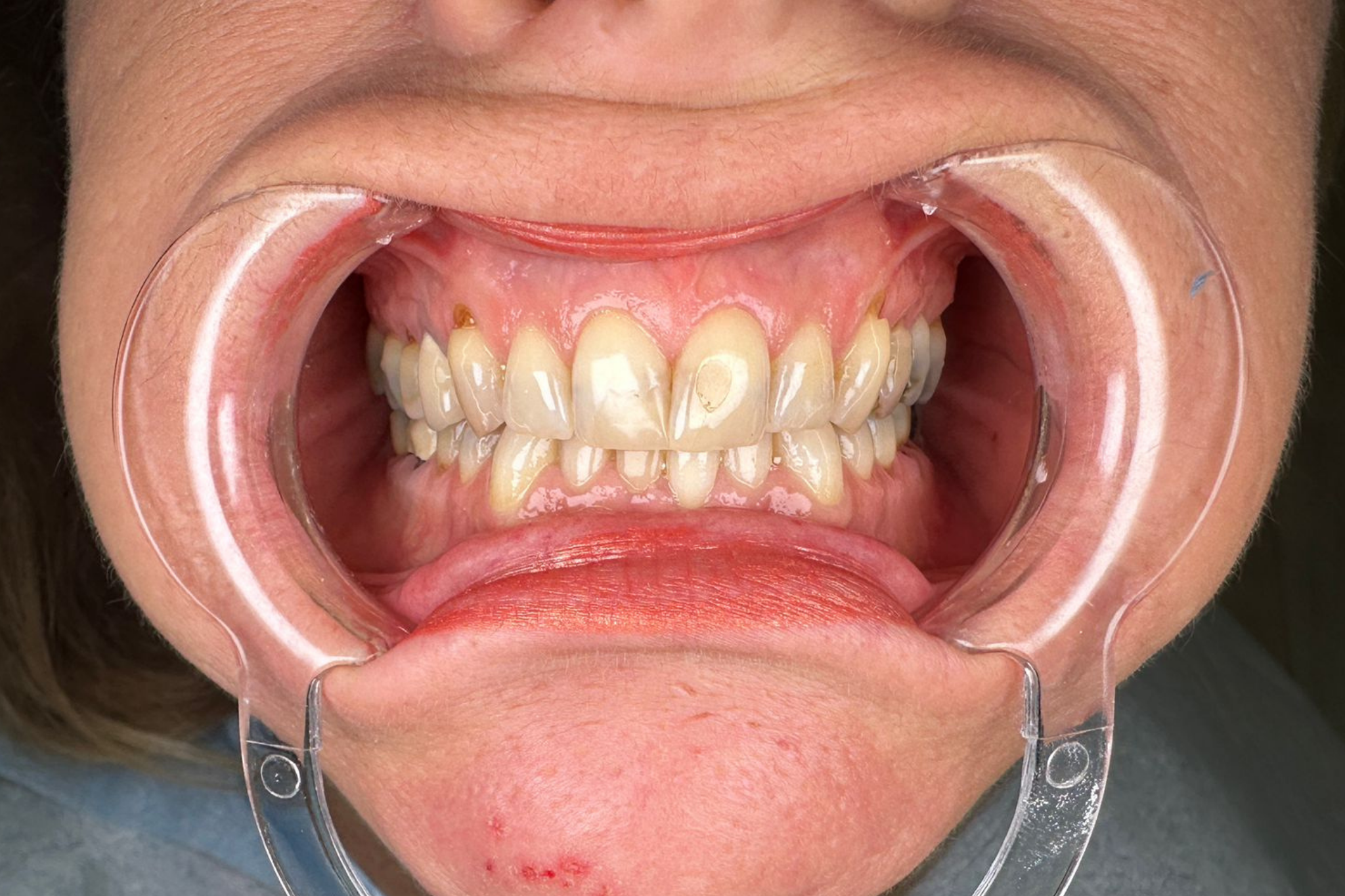 Before Zirconia Crown Treatment